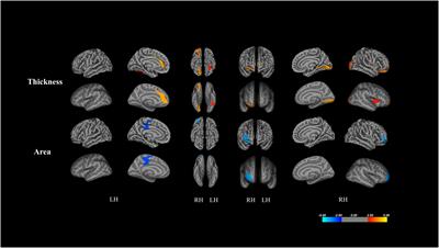 Social visual preference mediates the effect of cortical thickness on symptom severity in children with autism spectrum disorder